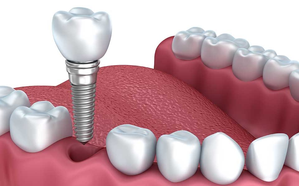 Dental Implants dentist benbrook tx