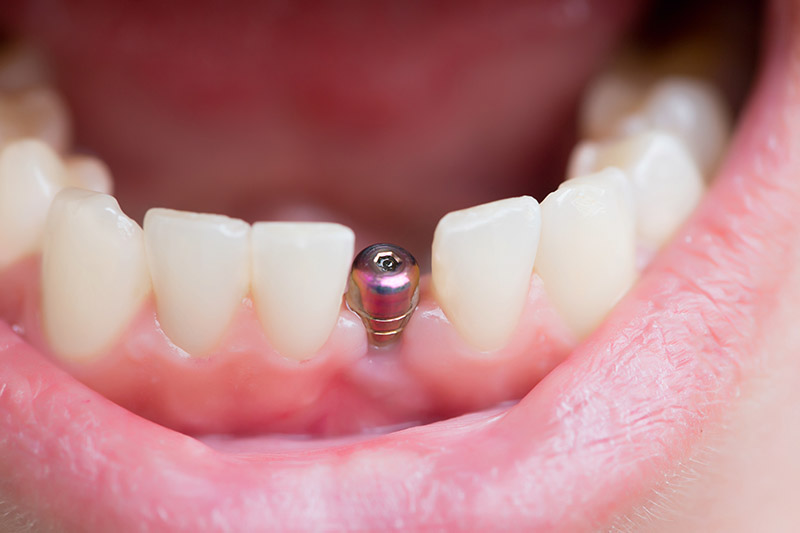 Are Dental Implants as Strong as Real Teeth?