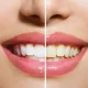 Teeth Whitening Service and Treatment at Rely Dental Clinic