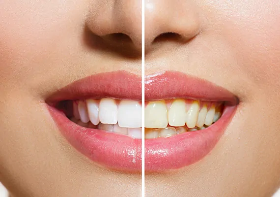Teeth Whitening Service and Treatment at Rely Dental Clinic