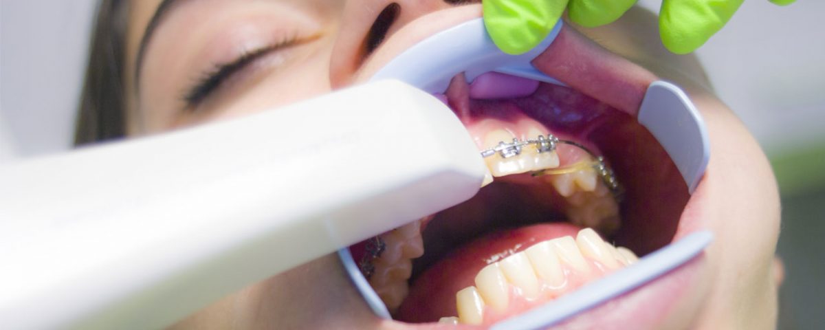 dentist scanning patients teeth with iTero scanner