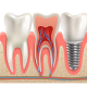 dental implants and tooth anatomy